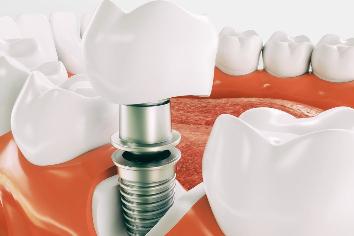 Cacciavite odontoiatrico per impianti dentali - NSI srl - manipolo